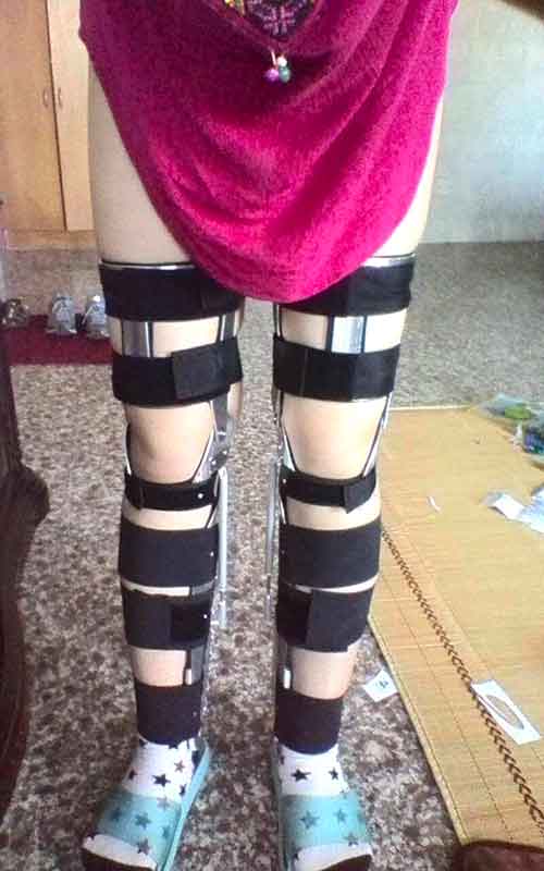 中老年女性O型腿矫正案例图片