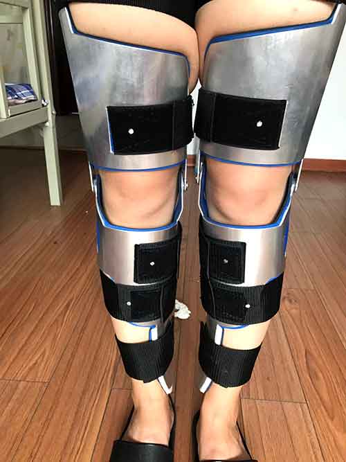 中青年男性X型腿矫正案例图片