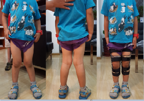 儿童X型腿矫正图片