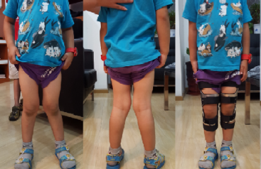 儿童X型腿矫正