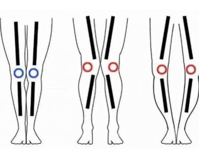 O型腿和X型腿是否也伴有其他骨骼问题