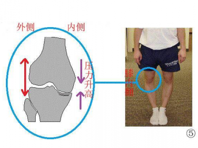 膝盖痛和O型腿有关系吗图片