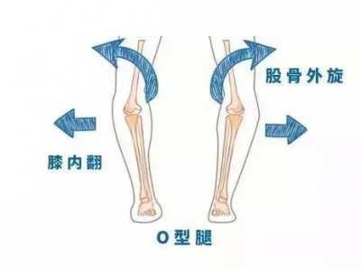 全面分析O型腿的形成图片