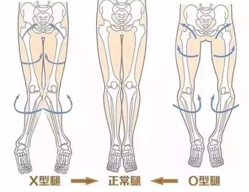 O型腿形成原因