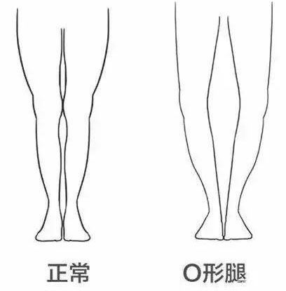 o型腿与正常腿图片图片