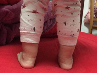 3岁宝宝x型腿图片