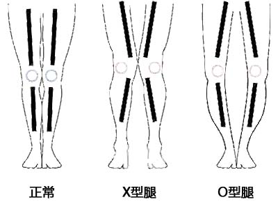 走路内八字怎么区分是O型腿还是X型腿