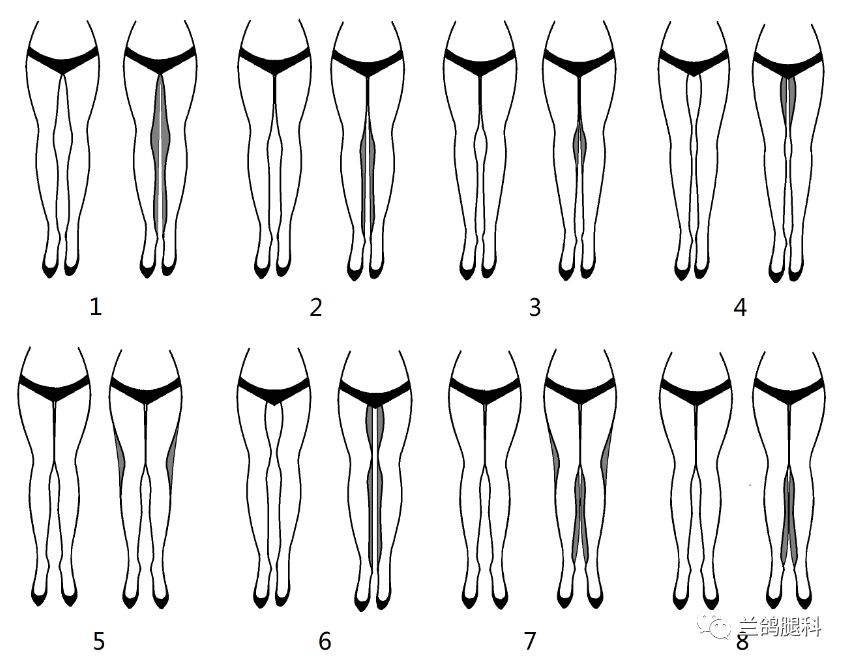 成人罗圈腿八种类型